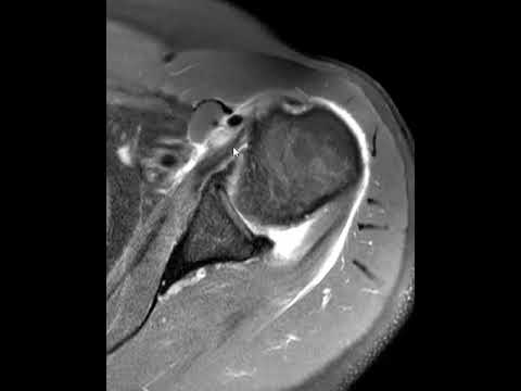 Biceps tendon dislocation and the pectoralis tendon insertion.