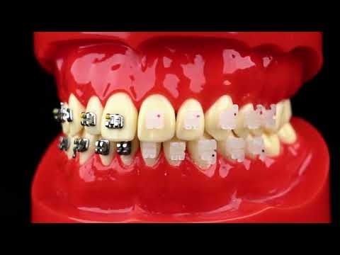 iDENTical Half Metal and Half Ceramic Brackets Orthodontic Models M3003