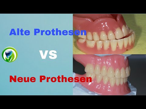 Alte Totalprothesen mit falschem Biss - neue Prothesen mit richtigem Biss -Patientenfall mit Fotos