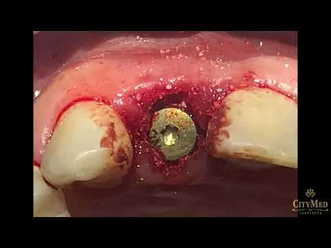 download lagu mp3 mp4 Hamba Implantaat, download lagu Hamba Implantaat gratis, unduh video klip Hamba Implantaat