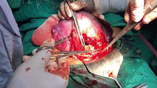 Cesarean delivery / c-section : Surgical technique