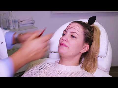 Anleitung zur Botox-Behandlung der Stirn: Tipps vom Experten