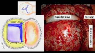 Microsurgical resection of a high-grade occipital AVM after staged embolization