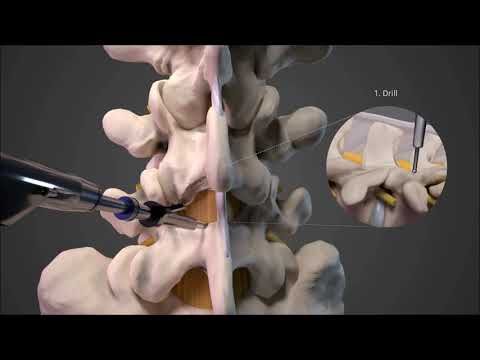 Full Endoscopic Stenosis Lumbar Decompression