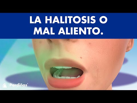 Mal aliento o Halitosis - ¿Qué la causa y cómo se cura? ©