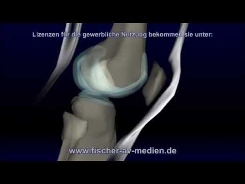 Intervertebrale Osteochondrose der Halswirbelsäule Tabletten von Salzablagerungen im Kniegelenk