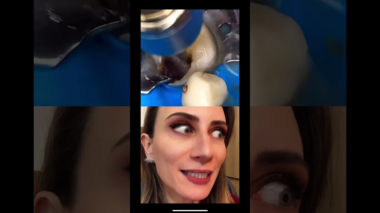 Você já viu se tem um pontinho preto desse???? #dente #cárie #dentista