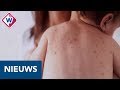 Mazelenuitbraak op Haags kinderdagverblijf - OMROEP WEST