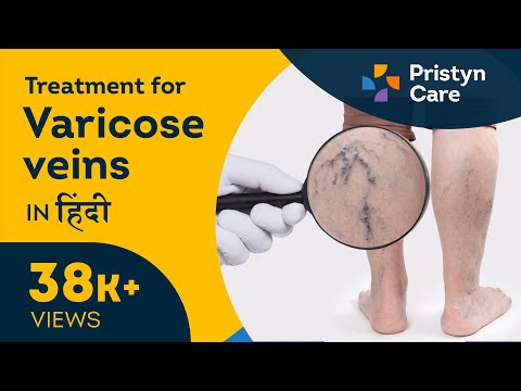 A varikózis tünetei a lábakon, Varikózis dermatitis és annak kezelése