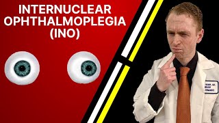 Neurologist Explains Internuclear Ophthalmoplegia (INO)