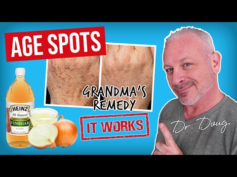 * Brown* AGE SPOT REMEDY: Onion Juice and ACV!