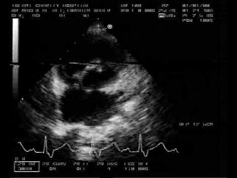 Coronary Artery To Left Ventricle Fistula (3/4)