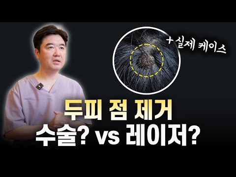 두피점 제거 레이저 흉터 머리카락 보존 회복기간 Q&A