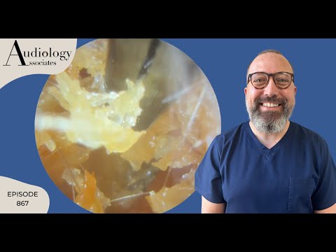 UNUSUAL & DIFFICULT KERATIN ENCASED EAR CANAL CLEARANCE - EP867