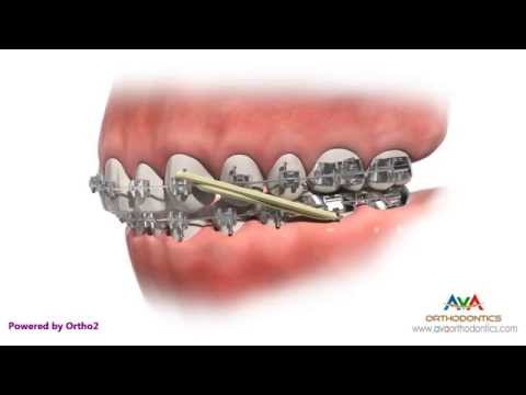Orthodontic Treatment for Overjet (Overbite) - Rubber Bands