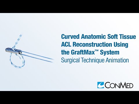 Curved anatomic soft tissue acl reconstruction using the gra...