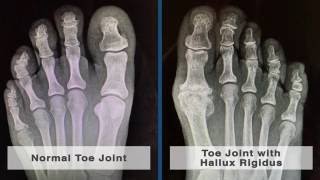 Causes and Treatment of Pain in the Big Toe Joint