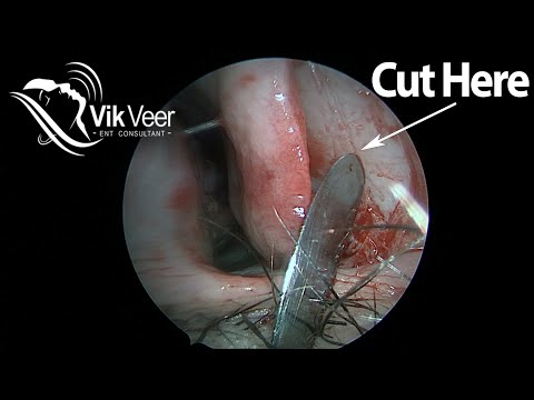 Watch a Septoplasty Operation