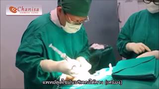 ดูดไขมันลดเหนียง
