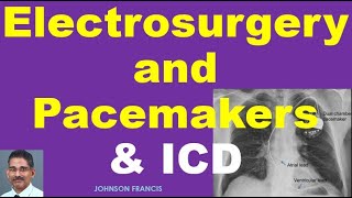Electrosurgery and Pacemakers &amp; ICD