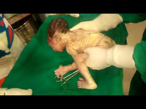 CAESAREAN Section सिजेरियन डिलीवरी कैसे होती है