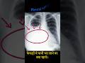 फेफड़ों मे पानी भर जाने पर Diet Pleural Effusion Diet फ�