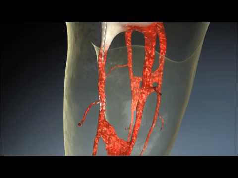 Mani D Finder Root Canal Orifice Locating Files.