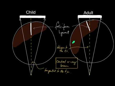 Pneumoperitoneum and the falciform ligament