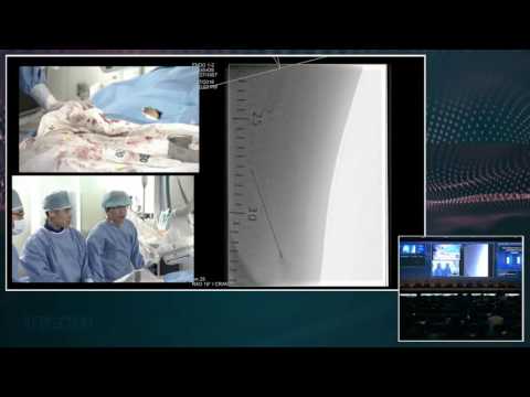 [Endovascular Symposium] Live Case Session I. SFA Intervention