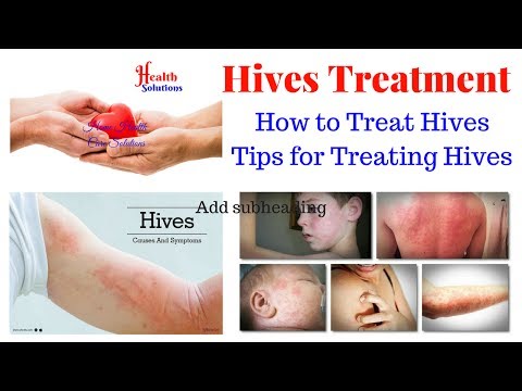 Hives Treatment - How to Treat Hives - Tips for Treating Hives Video