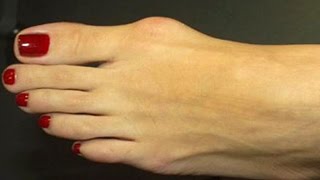 Home remedies for Bone Spurs