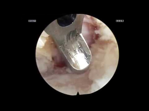 L5 Left Highly Down Migrated Extruded Disc iLESSYS