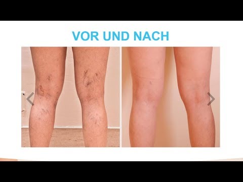 petele de pigment pe picioare în varicoza varico vase în tratament de sex masculin thaus