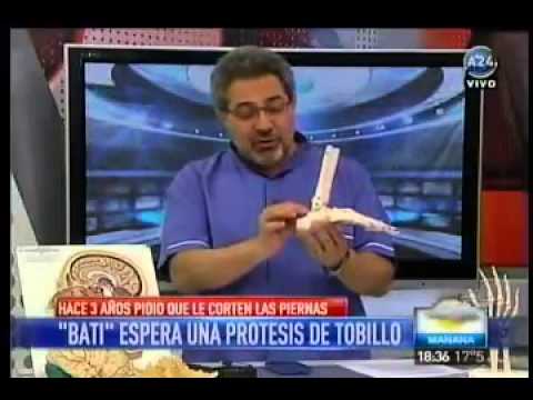 Batistuta espera una prótesis de tobillo