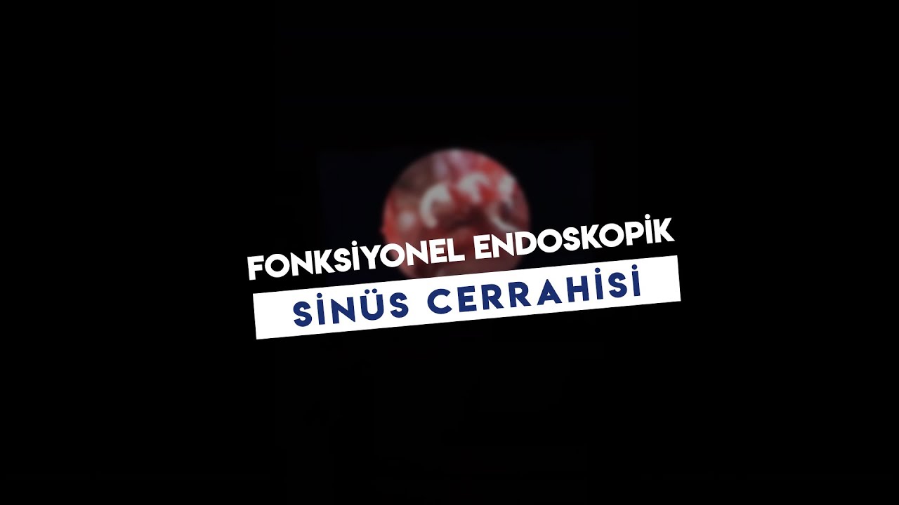 Fonksiyonel Endoskopik Sinüs Cerrahisi