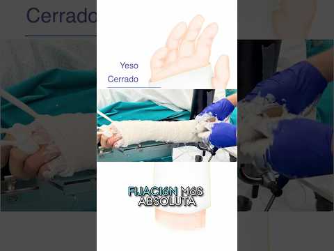¿Qué tipo de inmovilización necesitas para una fractura de muñeca o mano? Férulas y yesos explicados