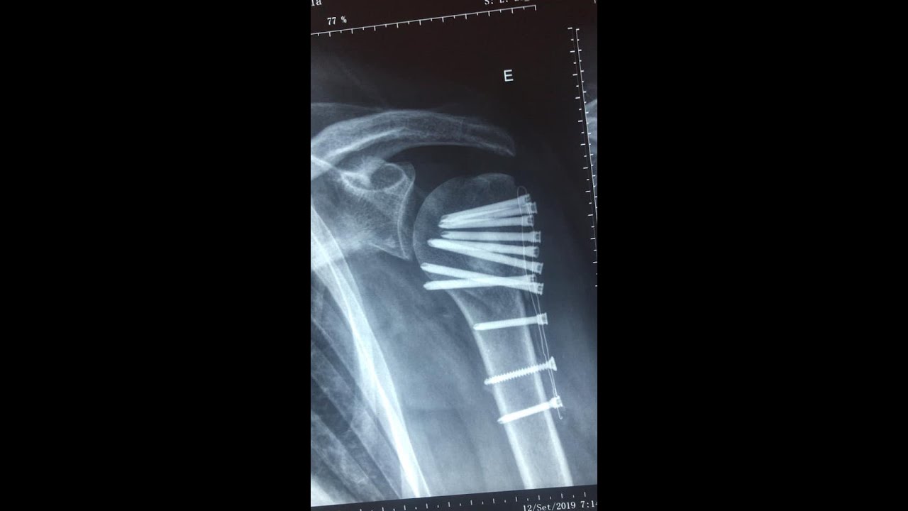 Pós Operatório Fratura Proximal do Úmero EVOLUÇÃO TRATAMENTO Clínica de Fisioterapia Dr Robson Sitta