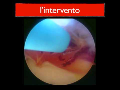 Ho spuntato larticolazione dellanca Protesi danca zimmer