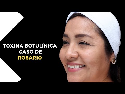 Caso de ROSARIO : Toxina botulínica