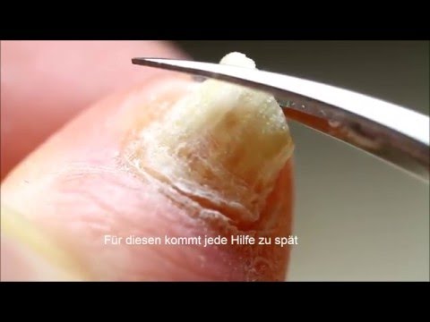 Video, wie gribok der Nägel zu behandeln Gribok auf dem Glied die Salbe