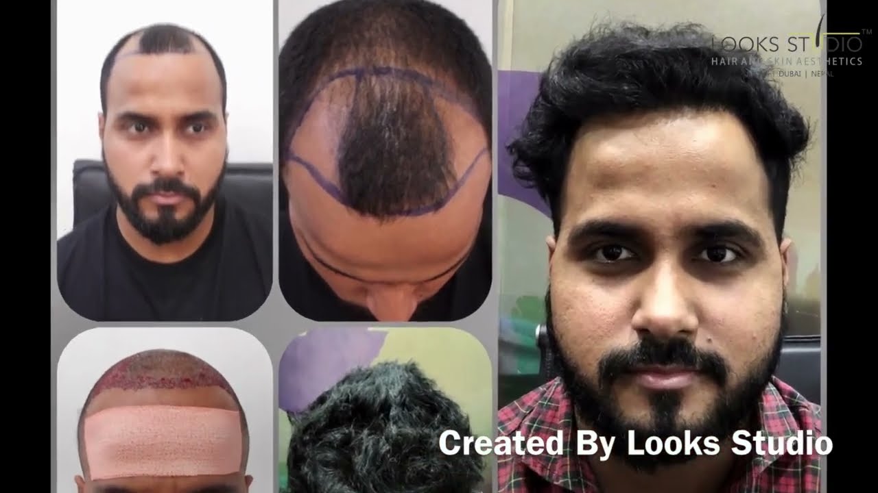 Incredible Hair Transformation: Client’s Journey to Full Satisfaction with Hair Transplant