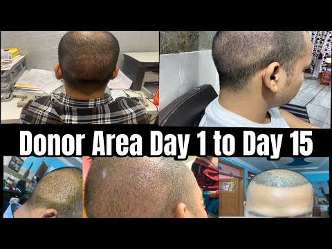 Donor Area recovery after hair transplant | Day 1 to 15