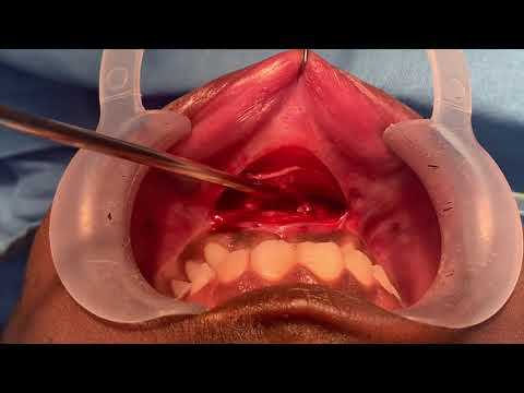 The Best Way To Remove A Cyst