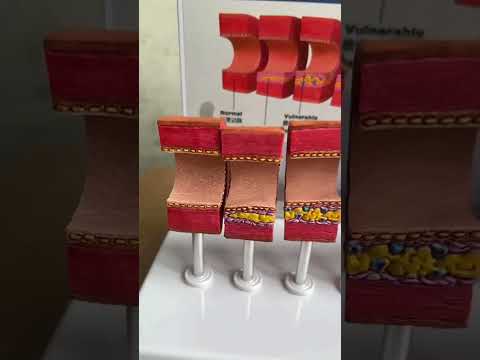 Модель атеросклероза - фото 1 - id-p2003295195