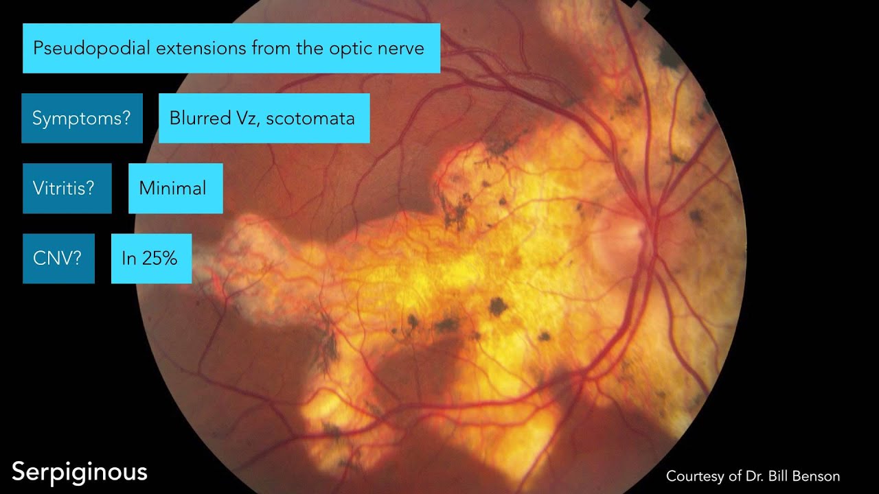 White Dot Syndromes - 2015 - YouTube