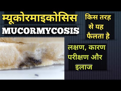 Mucormycosis kaise hota hai? || Mucormycosis ka ilaaj kya hai? || म्यूकोरमाइकोसिस का इलाज