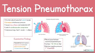 Tension Pneumothorax: Pathophysiology, Clinical signs & Symptoms, Diagnosis and treatment Explained