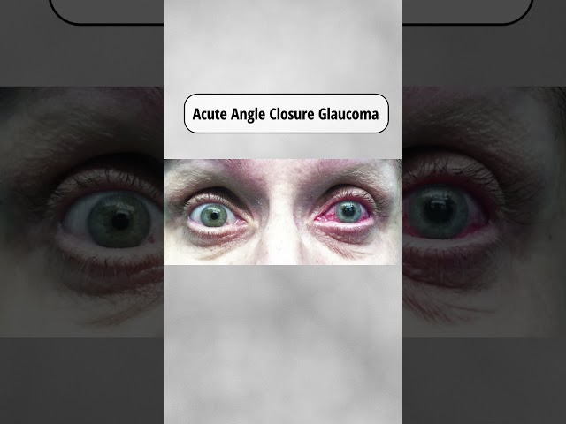 Silent Thief of Vision | Glaucoma Explained with Clinical Findings