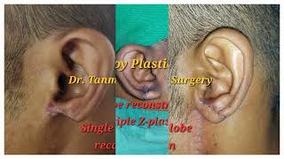 Plastic Surgery of Ear