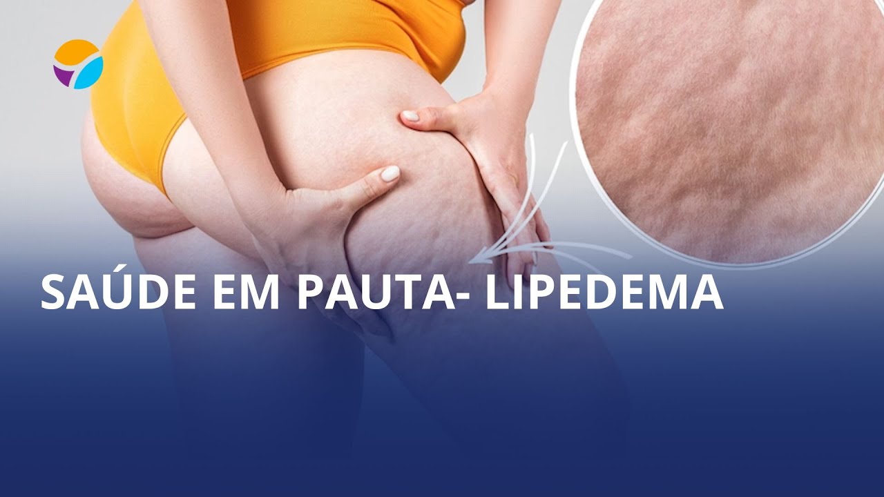 Você sabe o que é Lipedema? 🤔